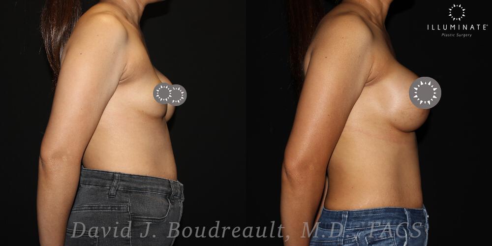 Breast Implant Revision Before & After Image