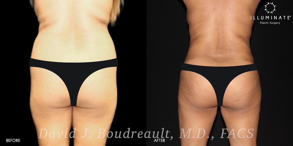 Brazilian Butt Lift  Before & After Image