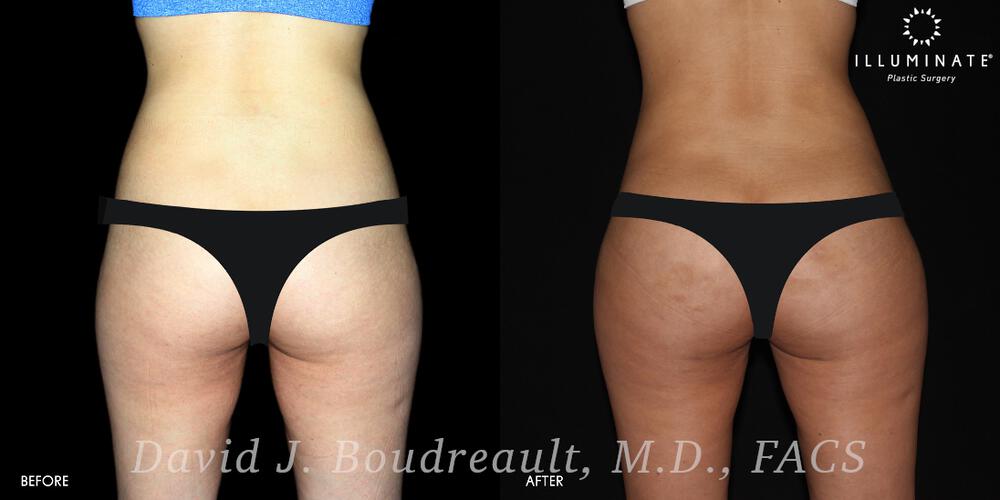 Brazilian Butt Lift  Before & After Image