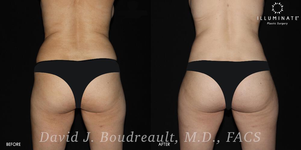 Brazilian Butt Lift  Before & After Image