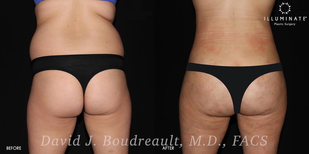 Brazilian Butt Lift  Before & After Image