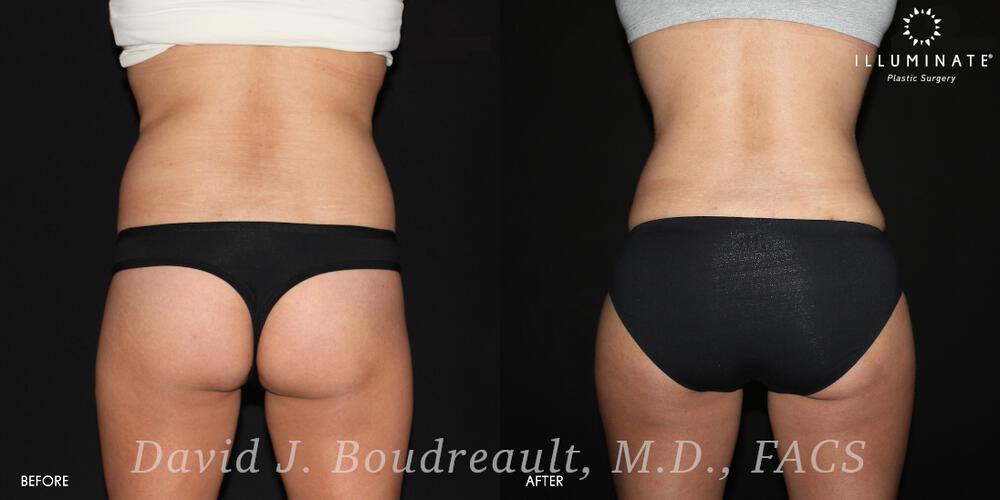 Brazilian Butt Lift  Before & After Image