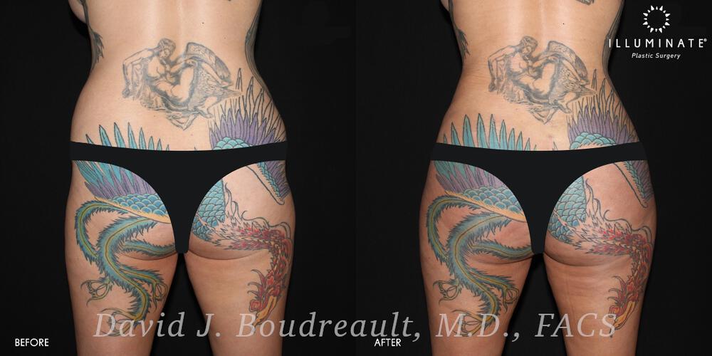 Brazilian Butt Lift  Before & After Image