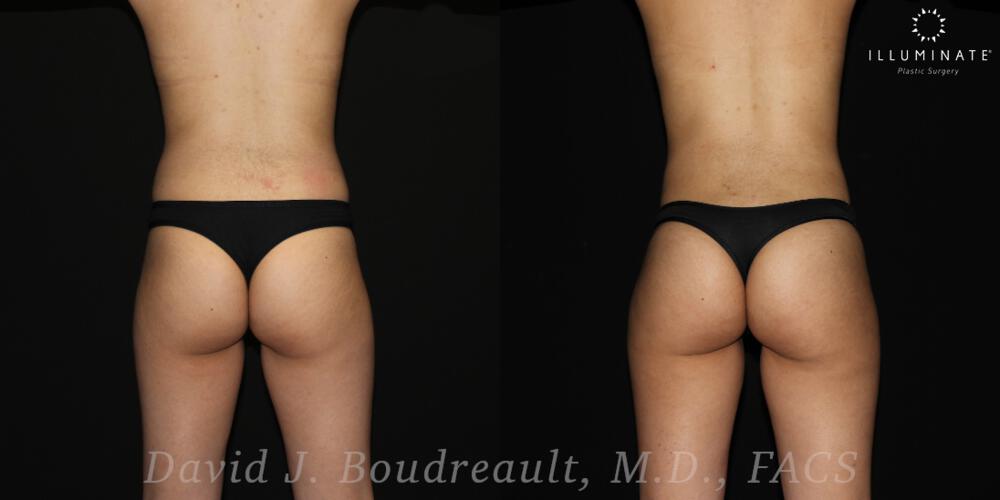 Brazilian Butt Lift  Before & After Image