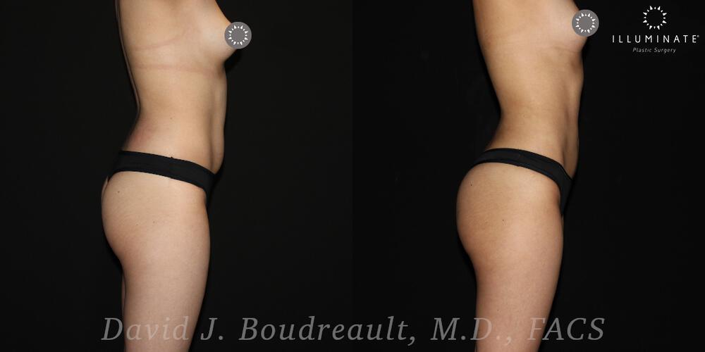 Brazilian Butt Lift  Before & After Image