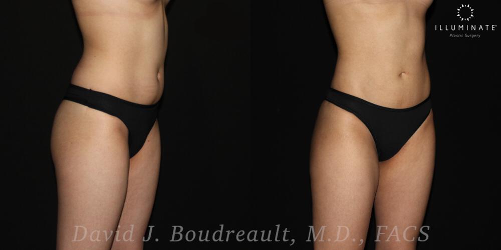 Brazilian Butt Lift  Before & After Image