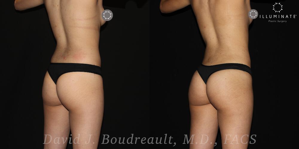 Brazilian Butt Lift  Before & After Image