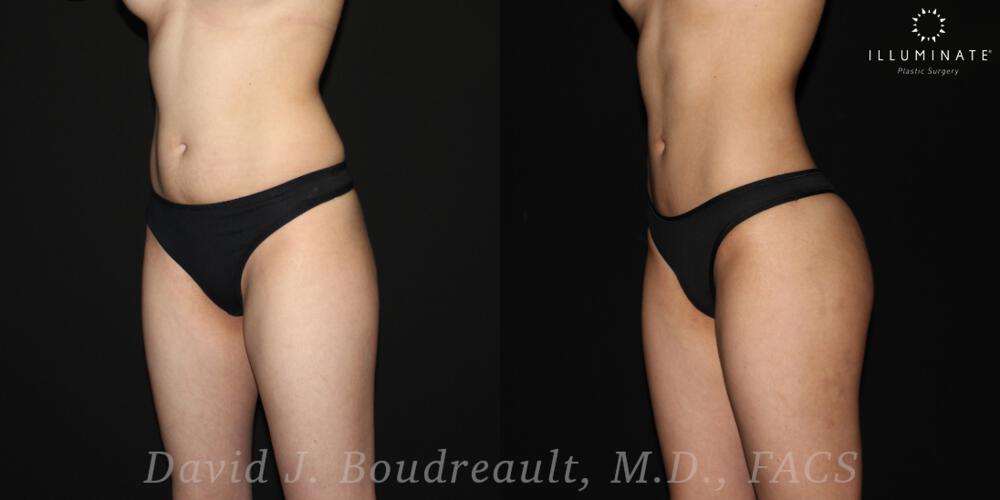 Brazilian Butt Lift  Before & After Image