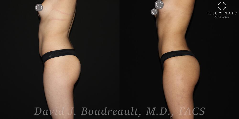 Brazilian Butt Lift  Before & After Image