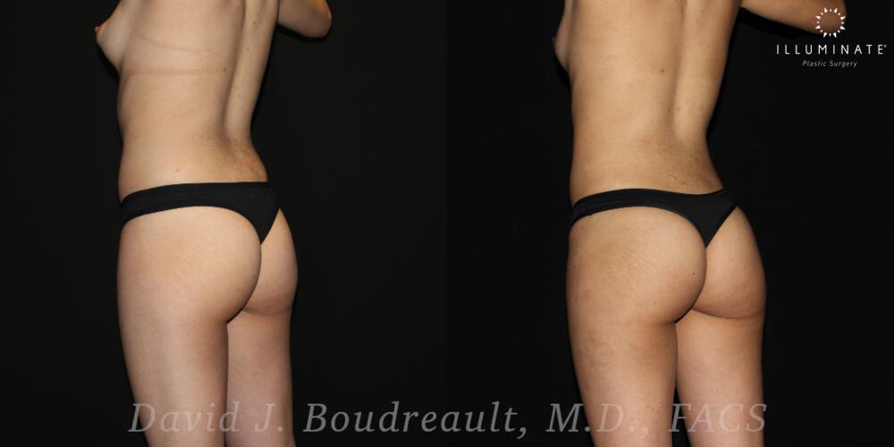 Brazilian Butt Lift  Before & After Image