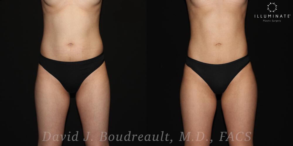 Brazilian Butt Lift  Before & After Image