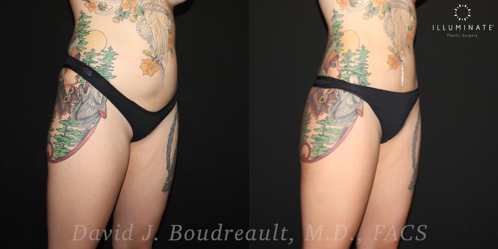 Brazilian Butt Lift  Before & After Image