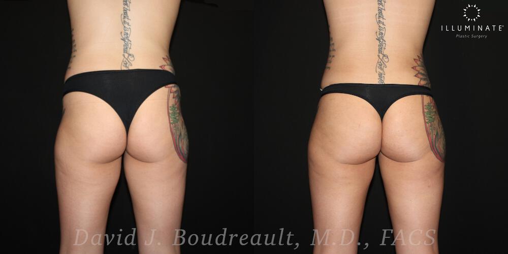 Brazilian Butt Lift  Before & After Image