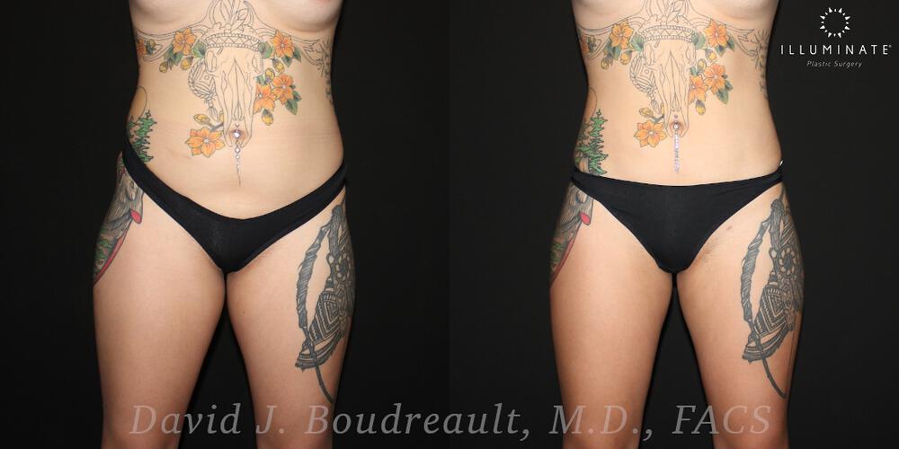 Brazilian Butt Lift  Before & After Image