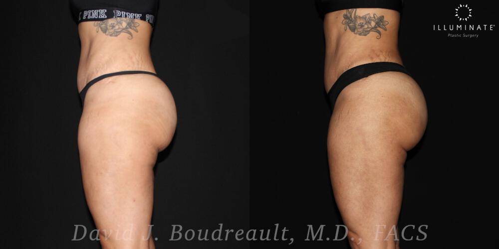 Brazilian Butt Lift  Before & After Image