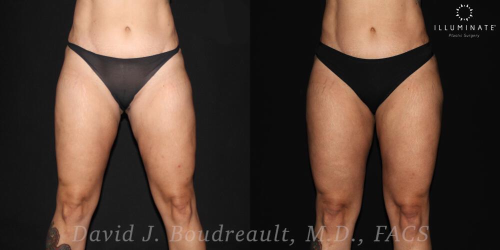 Brazilian Butt Lift  Before & After Image