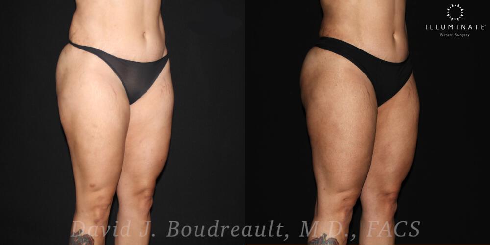 Brazilian Butt Lift  Before & After Image