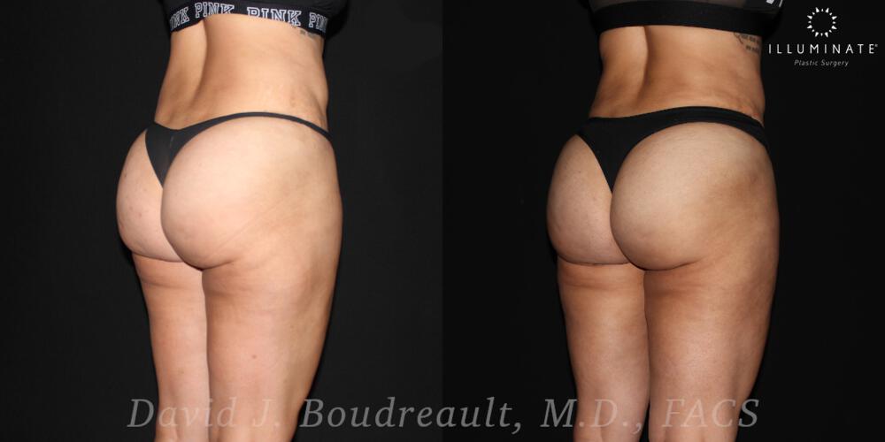 Brazilian Butt Lift  Before & After Image