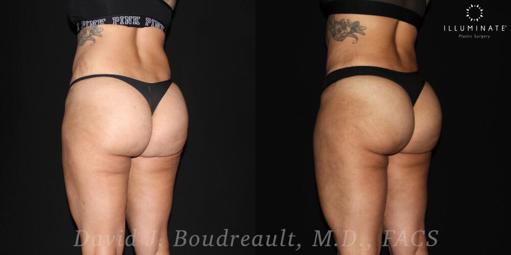 Brazilian Butt Lift  Before & After Image