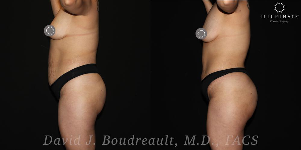 Brazilian Butt Lift  Before & After Image