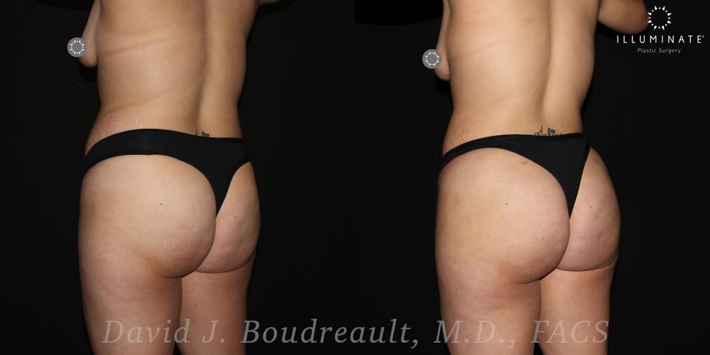 Brazilian Butt Lift  Before & After Image