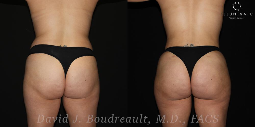 Brazilian Butt Lift  Before & After Image