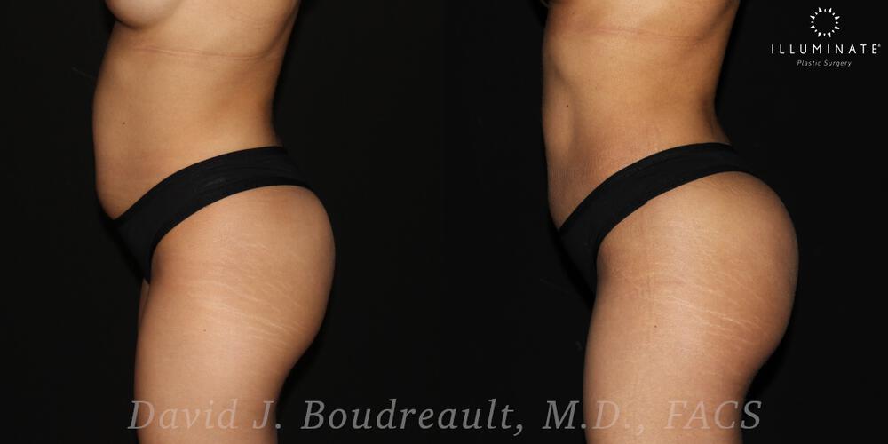 Brazilian Butt Lift  Before & After Image