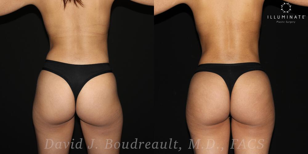 Brazilian Butt Lift  Before & After Image