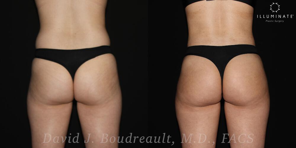 Brazilian Butt Lift  Before & After Image