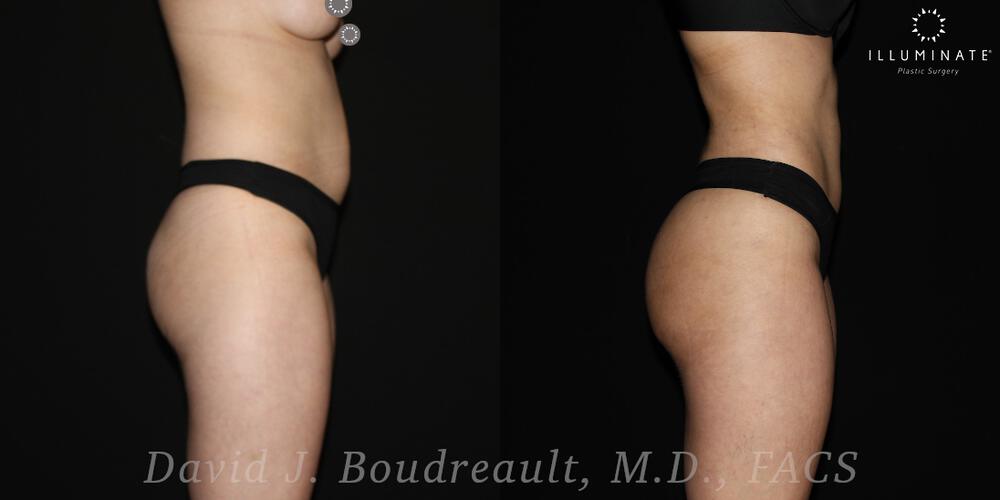 Brazilian Butt Lift  Before & After Image