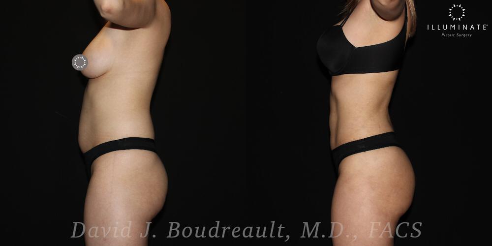 Brazilian Butt Lift  Before & After Image