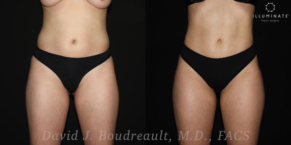 Brazilian Butt Lift  Before & After Image