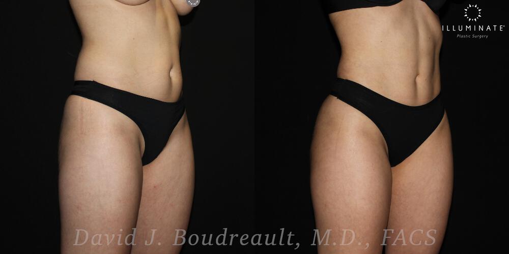 Brazilian Butt Lift  Before & After Image