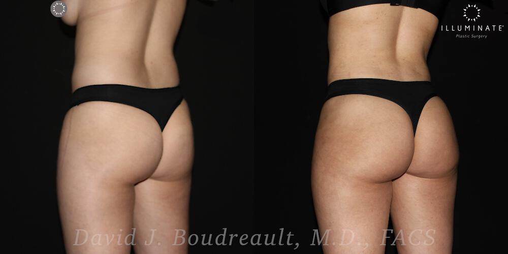 Brazilian Butt Lift  Before & After Image