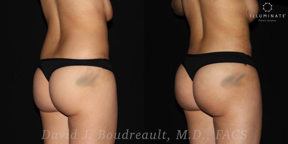 Brazilian Butt Lift  Before & After Image