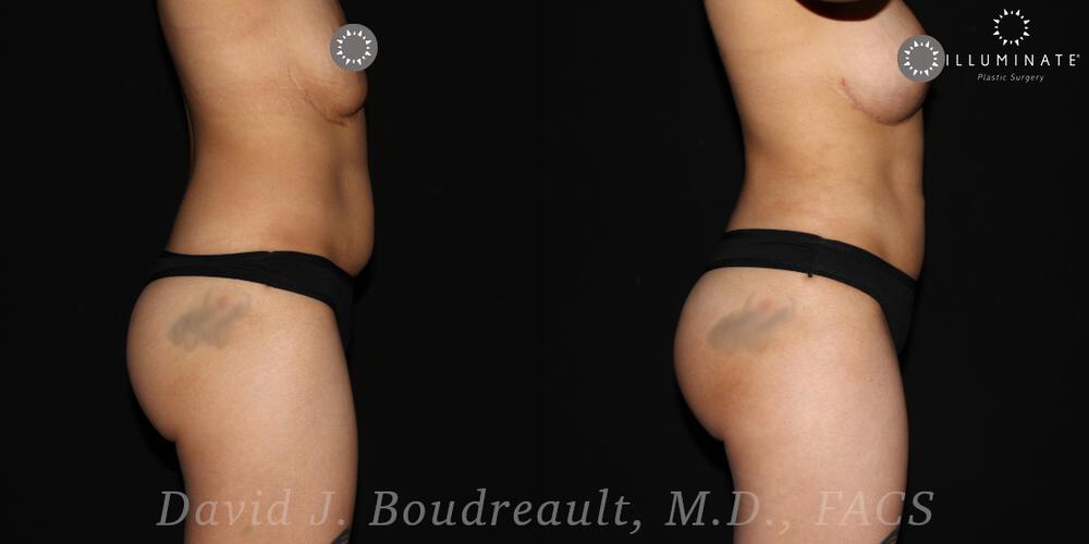 Brazilian Butt Lift  Before & After Image