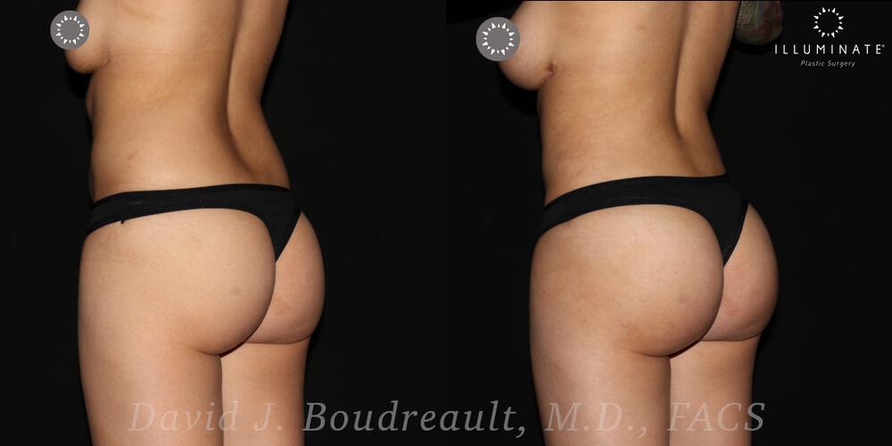 Brazilian Butt Lift  Before & After Image