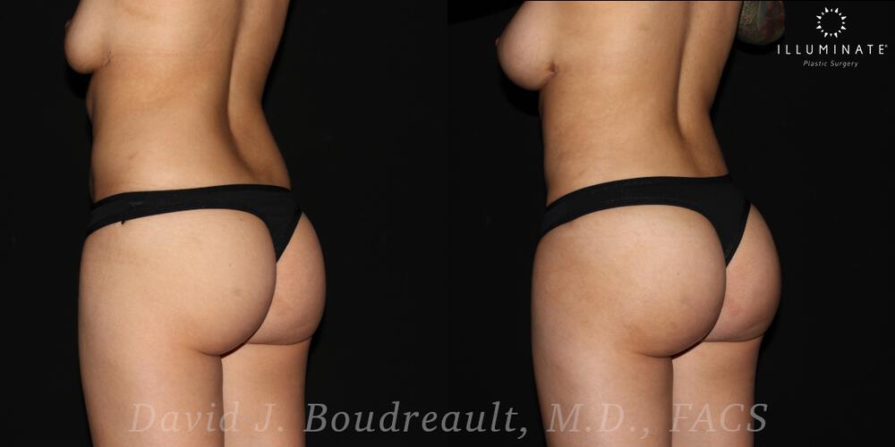 Brazilian Butt Lift  Before & After Image