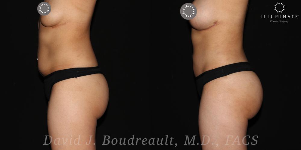 Brazilian Butt Lift  Before & After Image