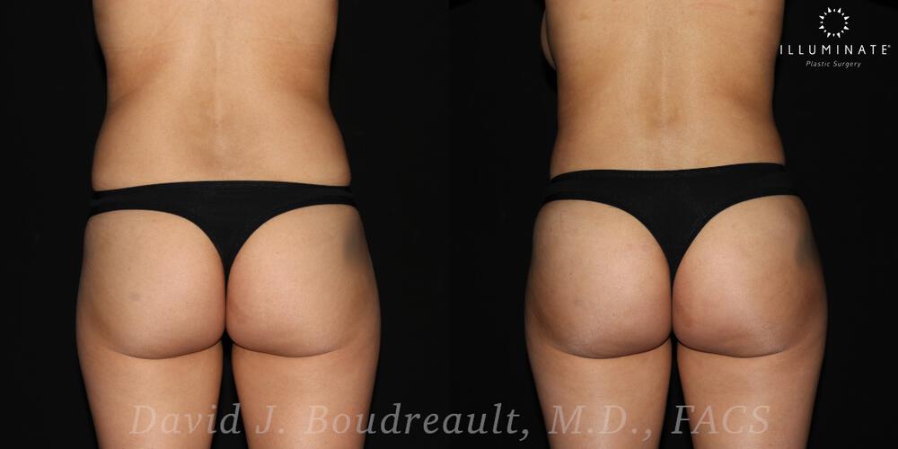 Brazilian Butt Lift  Before & After Image