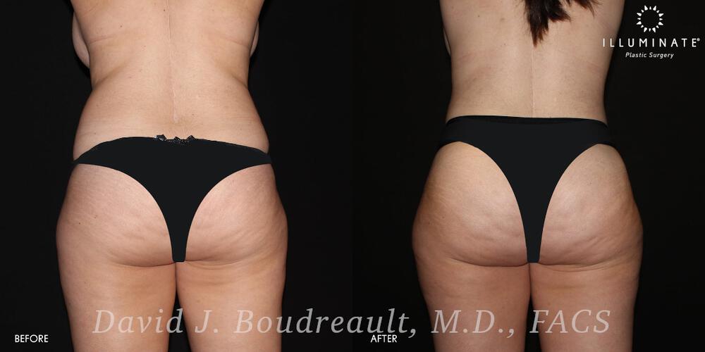 Brazilian Butt Lift  Before & After Image