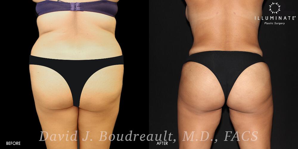 Brazilian Butt Lift  Before & After Image