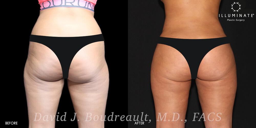 Brazilian Butt Lift  Before & After Image