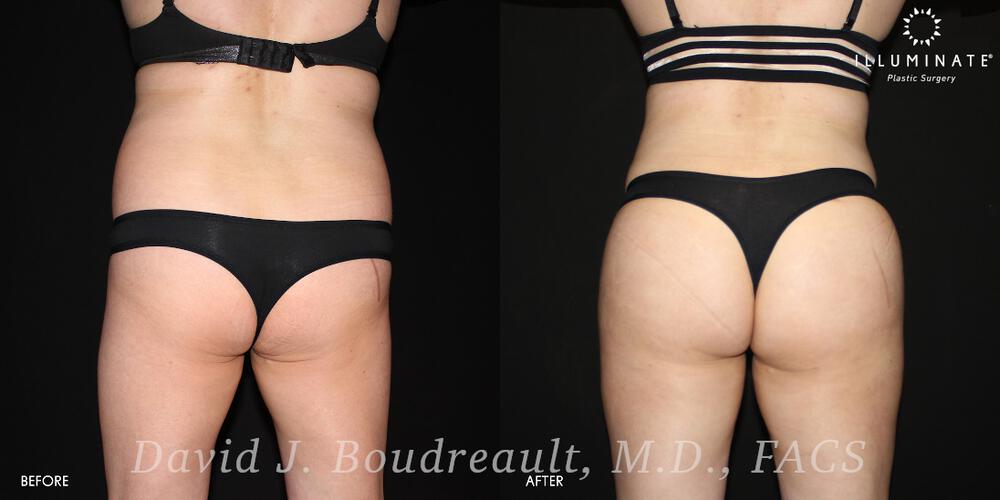 Brazilian Butt Lift  Before & After Image