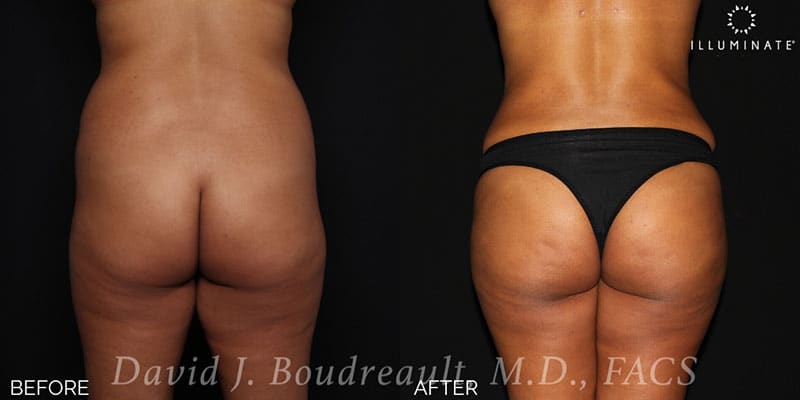 Brazilian Butt Lift  Before & After Image