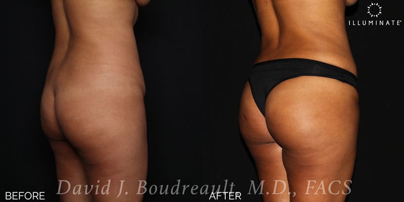 Brazilian Butt Lift  Before & After Image