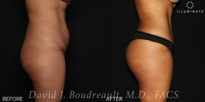 Brazilian Butt Lift  Before & After Image
