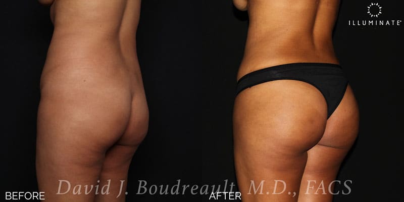 Brazilian Butt Lift  Before & After Image