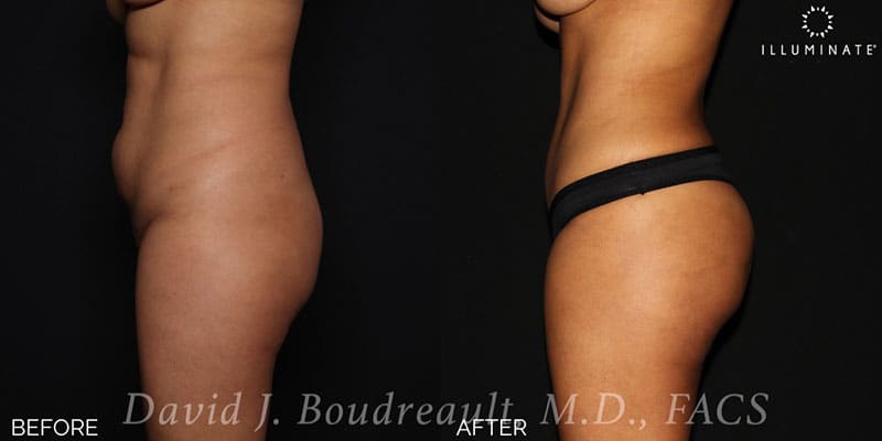 Brazilian Butt Lift  Before & After Image