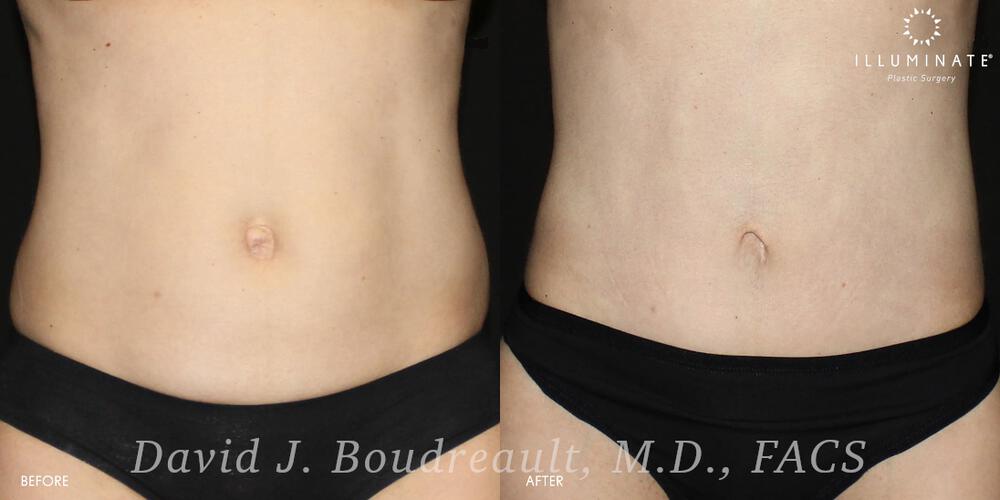 Liposuction Before & After Image